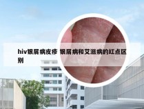 hiv银屑病皮疹 银屑病和艾滋病的红点区别