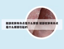 腿部皮肤有白点是什么原因 腿部皮肤有白点是什么原因引起的