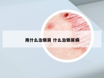 用什么治银屑 什么治银屑病