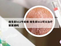 维生素b12牛皮癣 维生素b12可以治疗银屑病吗