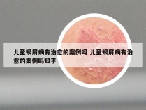 儿童银屑病有治愈的案例吗 儿童银屑病有治愈的案例吗知乎