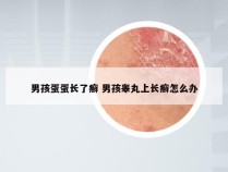 男孩蛋蛋长了癣 男孩睾丸上长癣怎么办