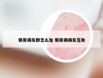 银屑病友群怎么加 银屑病病友互助