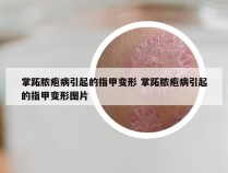 掌跖脓疱病引起的指甲变形 掌跖脓疱病引起的指甲变形图片