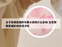 女子有银屑病怀孕要小孩有什么影响 女生得银屑病影响生孩子吗