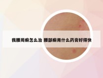 我腰周癣怎么治 腰部癣用什么药膏好得快