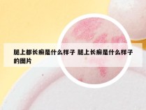 腿上都长癣是什么样子 腿上长癣是什么样子的图片