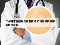 广州哪家医院牛皮癣看的好 广州看银屑病哪家医院最好