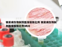 银屑病生物制剂医保报销比例 银屑病生物制剂医保报销比例l四川