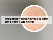 生物制剂密集针是患处的每个部位吗 生物制剂密集针是患处的每个部位吗