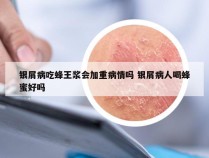 银屑病吃蜂王浆会加重病情吗 银屑病人喝蜂蜜好吗