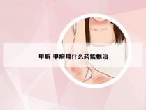 甲癣 甲癣用什么药能根治