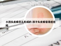 小孩头皮癣怎么形成的 孩子头皮癣容易痊愈吗