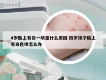 4岁脸上有白一块是什么原因 四岁孩子脸上有白色块怎么办