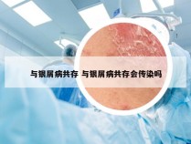 与银屑病共存 与银屑病共存会传染吗