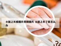 小腿上长癣图片初期图片 小腿上长了藓怎么办