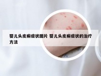 婴儿头皮癣症状图片 婴儿头皮癣症状的治疗方法