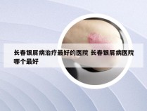 长春银屑病治疗最好的医院 长春银屑病医院哪个最好