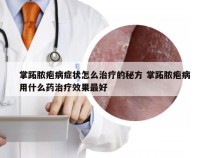 掌跖脓疱病症状怎么治疗的秘方 掌跖脓疱病用什么药治疗效果最好