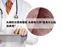 头癣的分类有哪些 头癣有几种?各有什么临床表现?