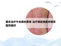 重庆治疗牛皮癣的费用 治疗银屑病重庆哪家医院最好