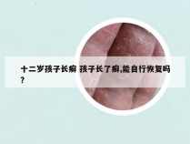 十二岁孩子长癣 孩子长了癣,能自行恢复吗?