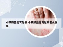 小孩膝盖腿弯起癣 小孩膝盖腿弯起癣怎么回事