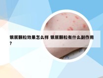 银屑颗粒效果怎么样 银屑颗粒有什么副作用?