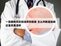 一张图教你区别湿疹和股癣 怎么判断是股癣还是阴囊湿疹