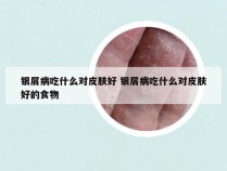 银屑病吃什么对皮肤好 银屑病吃什么对皮肤好的食物