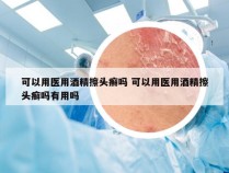 可以用医用酒精擦头癣吗 可以用医用酒精擦头癣吗有用吗