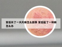 背后长了一大片癣怎么回事 背后起了一块癣怎么办