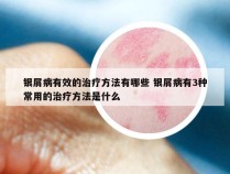 银屑病有效的治疗方法有哪些 银屑病有3种常用的治疗方法是什么