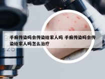 手癣传染吗会传染给家人吗 手癣传染吗会传染给家人吗怎么治疗