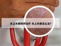 头上长癣如何治疗 头上长癣怎么治?