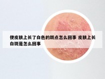 使皮肤上长了白色的斑点怎么回事 皮肤上长白斑是怎么回事