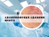 儿童点滴状银屑病不易复发 儿童点滴状银屑病终身不犯