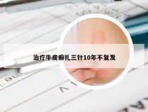 治疗牛皮癣扎三针10年不复发