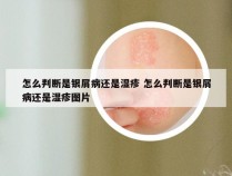 怎么判断是银屑病还是湿疹 怎么判断是银屑病还是湿疹图片