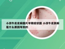 小孩牛皮皮癣图片早期症状图 小孩牛皮肤癣是什么原因导致的