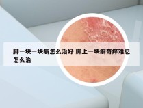 脚一块一块癣怎么治好 脚上一块癣奇痒难忍怎么治