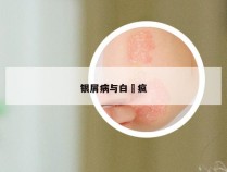 银屑病与白癲疯