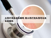 小苏打洗头治头癣吗 用小苏打洗头发可以去头皮屑吗