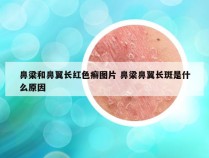 鼻梁和鼻翼长红色癣图片 鼻梁鼻翼长斑是什么原因