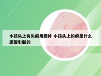 小孩头上有头癣用图片 小孩头上的癣是什么原因引起的