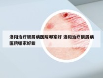 洛阳治疗银屑病医院哪家好 洛阳治疗银屑病医院哪家好些