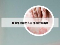 典型牛皮癣怎么治 牛皮肤癣类型