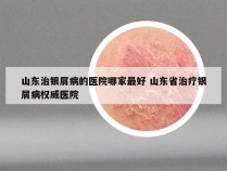 山东治银屑病的医院哪家最好 山东省治疗银屑病权威医院