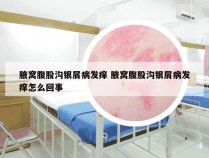 腋窝腹股沟银屑病发痒 腋窝腹股沟银屑病发痒怎么回事