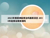 2023年银屑病能根治吗最新消息 2030年能根治银屑病吗